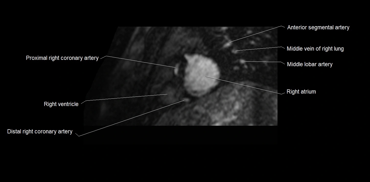 MRI heart and coronary arteries two chamber(sagittal)  anatomy image 4.webp